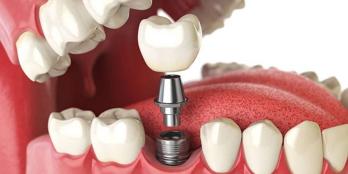 Имплантология - Стоматологія на Березняках Ci-Dentl